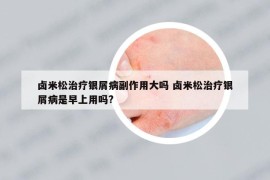 鹵米松治療銀屑病副作用大嗎 鹵米松治療銀屑病是早上用嗎?