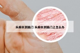 頭癬長到腦門 頭癬長到腦門上怎么辦