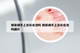 銀屑病手上會長水泡嗎 銀屑病手上會長水泡嗎圖片