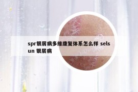 spr銀屑病多維康復體系怎么樣 selsun 銀屑病
