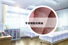 牛皮癬能吃麻油