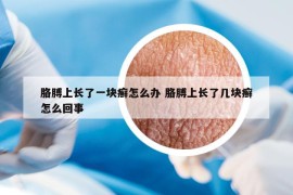胳膊上長(zhǎng)了一塊癬怎么辦 胳膊上長(zhǎng)了幾塊癬怎么回事
