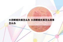 小孩眼睛長癬怎么辦 小孩眼睛長癬怎么回事怎么辦