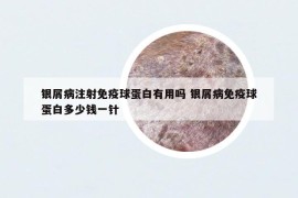 銀屑病注射免疫球蛋白有用嗎 銀屑病免疫球蛋白多少錢一針