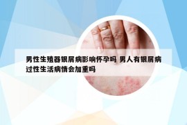男性生殖器銀屑病影響懷孕嗎 男人有銀屑病過性生活病情會(huì)加重嗎