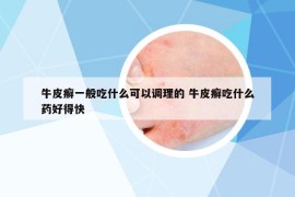 牛皮癬一般吃什么可以調(diào)理的 牛皮癬吃什么藥好得快