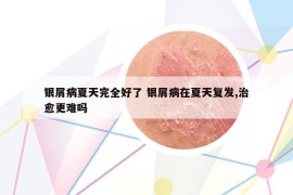 銀屑病夏天完全好了 銀屑病在夏天復(fù)發(fā),治愈更難嗎