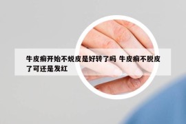 牛皮癬開(kāi)始不蛻皮是好轉(zhuǎn)了嗎 牛皮癬不脫皮了可還是發(fā)紅