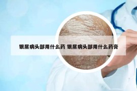 銀屑病頭部用什么藥 銀屑病頭部用什么藥膏