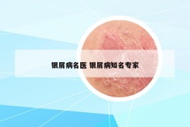 銀屑病名醫(yī) 銀屑病知名專家