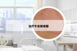治療牛皮癬用醋