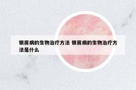 銀屑病的生物治療方法 銀屑病的生物治療方法是什么