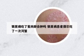 銀屑病吃了鱟肉腳會(huì)腫嗎 銀屑病患者偶爾吃了一次河蟹