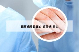 銀屑病導(dǎo)致死亡 銀屑病 死亡
