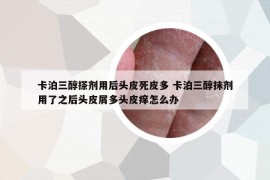 卡泊三醇搽劑用后頭皮死皮多 卡泊三醇抹劑用了之后頭皮屑多頭皮癢怎么辦