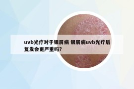 uvb光療對于銀屑病 銀屑病uvb光療后復(fù)發(fā)會更嚴重嗎?