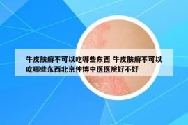 牛皮膚癬不可以吃哪些東西 牛皮膚癬不可以吃哪些東西北京仲博中醫(yī)醫(yī)院好不好