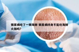 銀屑病吃了一頓海鮮 銀屑病終身不能吃海鮮火鍋嗎?