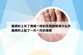 胳膊肘上長(zhǎng)了像癬一樣的東西很癢用什么藥 胳膊肘上起了一片一片的像癬