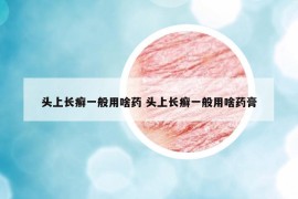 頭上長癬一般用啥藥 頭上長癬一般用啥藥膏