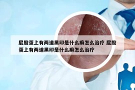 屁股蛋上有兩道黑印是什么癬怎么治療 屁股蛋上有兩道黑印是什么癬怎么治療
