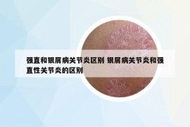 強(qiáng)直和銀屑病關(guān)節(jié)炎區(qū)別 銀屑病關(guān)節(jié)炎和強(qiáng)直性關(guān)節(jié)炎的區(qū)別