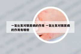 一氧化氮對(duì)銀屑病的作用 一氧化氮對(duì)銀屑病的作用有哪些