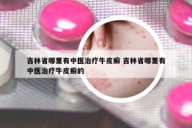 吉林省哪里有中醫(yī)治療牛皮癬 吉林省哪里有中醫(yī)治療牛皮癬的