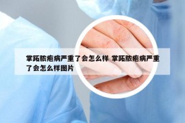 掌跖膿皰病嚴(yán)重了會(huì)怎么樣 掌跖膿皰病嚴(yán)重了會(huì)怎么樣圖片