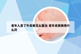 老年人患了牛皮癬怎么醫(yī)治 老年皮膚癬用什么藥