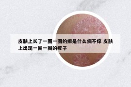 皮膚上長了一圈一圈的癬是什么病不癢 皮膚上出現(xiàn)一圈一圈的疹子