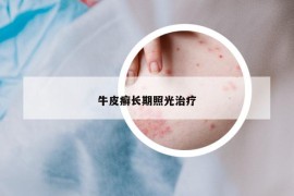 牛皮癬長期照光治療