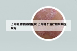 上海哪里銀屑病醫(yī)院 上海哪個(gè)治療銀屑病醫(yī)院好
