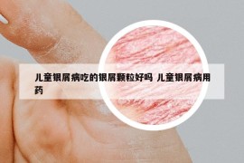 兒童銀屑病吃的銀屑顆粒好嗎 兒童銀屑病用藥