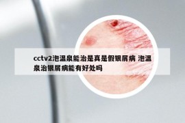cctv2泡溫泉能治是真是假銀屑病 泡溫泉治銀屑病能有好處嗎