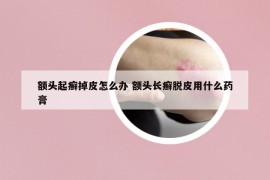 額頭起癬掉皮怎么辦 額頭長癬脫皮用什么藥膏