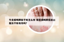 牛皮癬喝脾肽干粉怎么樣 銀屑病喝脾氨肽口服凍干粉有效嗎?