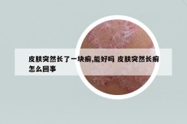 皮膚突然長(zhǎng)了一塊癬,能好嗎 皮膚突然長(zhǎng)癬怎么回事