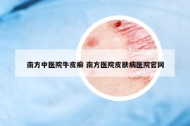 南方中醫(yī)院牛皮癬 南方醫(yī)院皮膚病醫(yī)院官網(wǎng)