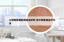 小孩銀屑病能徹底治好嗎 孩子銀屑病治療方法