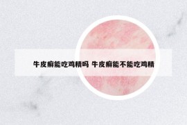 牛皮癬能吃雞精嗎 牛皮癬能不能吃雞精
