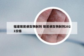 福建銀屑病生物制劑 銀屑病生物制劑2021價(jià)格