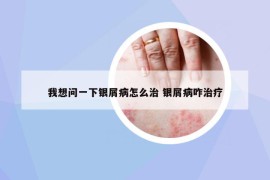 我想問一下銀屑病怎么治 銀屑病咋治療