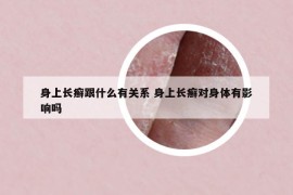 身上長(zhǎng)癬跟什么有關(guān)系 身上長(zhǎng)癬對(duì)身體有影響嗎