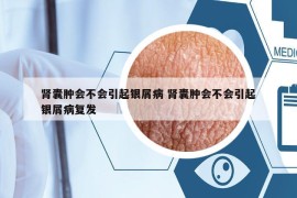 腎囊腫會不會引起銀屑病 腎囊腫會不會引起銀屑病復(fù)發(fā)