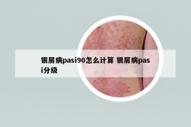 銀屑病pasi90怎么計(jì)算 銀屑病pasi分級(jí)