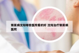 銀屑病沈陽哪些醫(yī)院看的好 沈陽治療銀屑病醫(yī)院