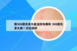 做308激光多久能治好白癜風(fēng) 308激光多久做一次比較好
