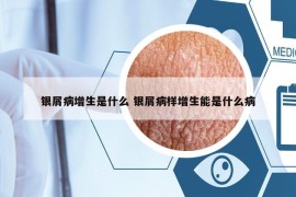 銀屑病增生是什么 銀屑病樣增生能是什么病