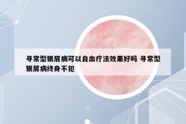 尋常型銀屑病可以自血療法效果好嗎 尋常型銀屑病終身不犯